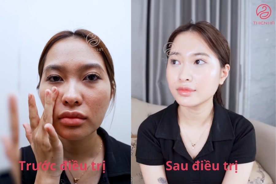 Phương Trinh (MC - 26 tuổi) sau khi trực tiếp thực hiện trẻ hoá cùng chuyên bác sĩ Trần Vương Thế Vinh