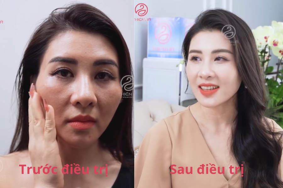 Hà Đinh - 37 tuổi đã hoàn toàn bị thuyết phục với phương pháp điều trị lão hoá gốc tế bào