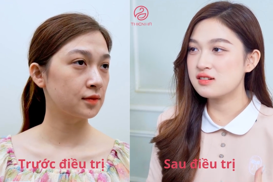 Kim Phượng (25 tuổi) sau 60p điều trị lão hoá gốc tế bào da căng bóng, má baby, mờ rãnh cười, trẻ hơn chục tuổi
