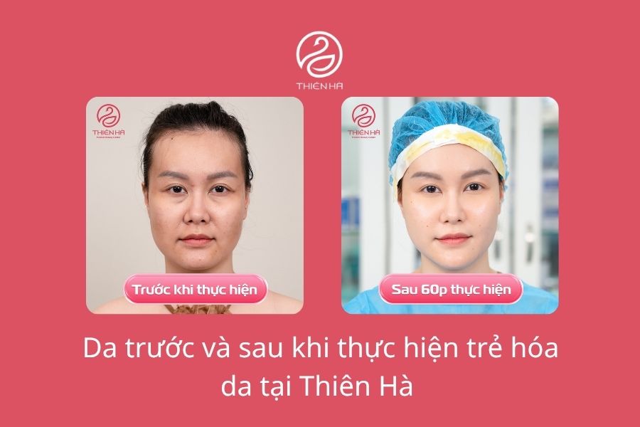 Trẻ hóa da ở đâu uy tín? Tiêu chí và địa chỉ trẻ hóa tốt tại Hà Nội 10 Da căng bóng, sáng mịn chỉ sau 60p thực hiện trẻ hóa tại Thẩm mỹ viện Thiên Hà