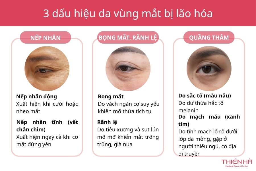 Bọng mắt, quầng thâm và vết chân chim là dấu hiệu vùng mắt đang lão hóa 