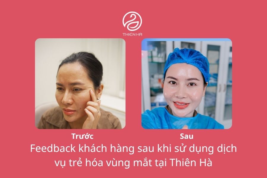 Hình ảnh khách hàng sau thực hiện trẻ hóa vùng mắt tại Thẩm mỹ viện Thiên Hà 