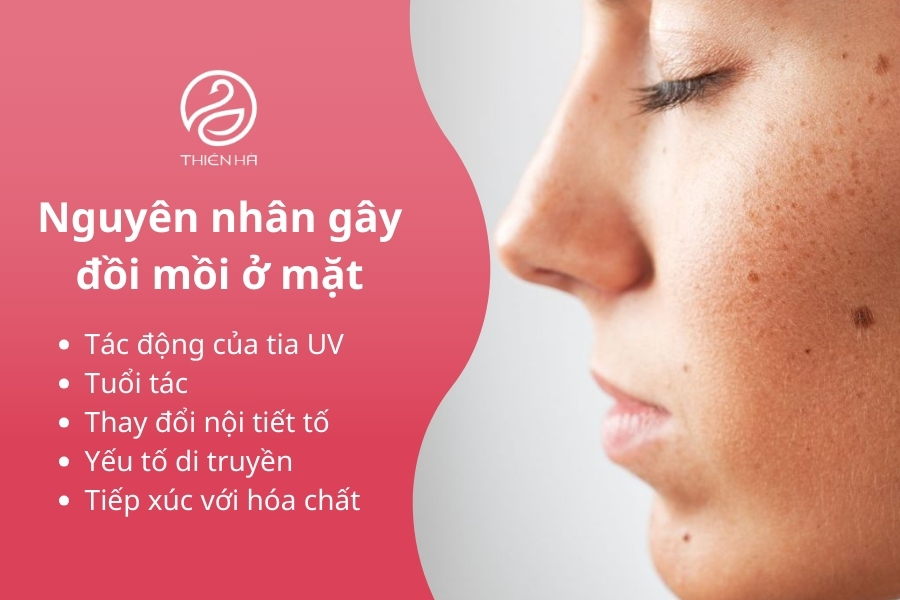 Đồi mồi xuất hiện chủ yếu do làn da của bạn tiếp xúc quá nhiều với ánh nắng mặt trời gay gắt hoặc đó là dấu hiệu của tình trạng lão hóa.