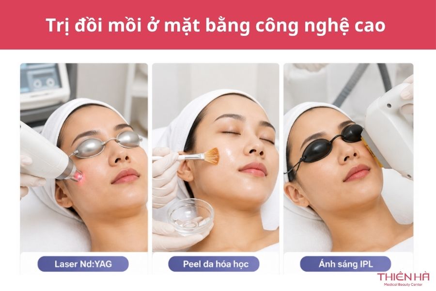 Hướng dẫn trị đồi mồi ở mặt đúng cách, ngừa tái phát hiệu quả 2 Trị đồi mồi ở mặt bằng công nghệ cao: Hiệu quả nhanh, rõ rệt