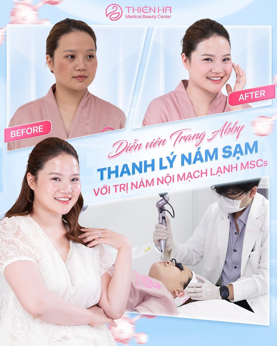 Trị nám bằng laser bao nhiêu tiền? Giá từng công nghệ mới nhất 4 Ứng dụng trị nám nội mạch lạnh MSCs cho khách hàng