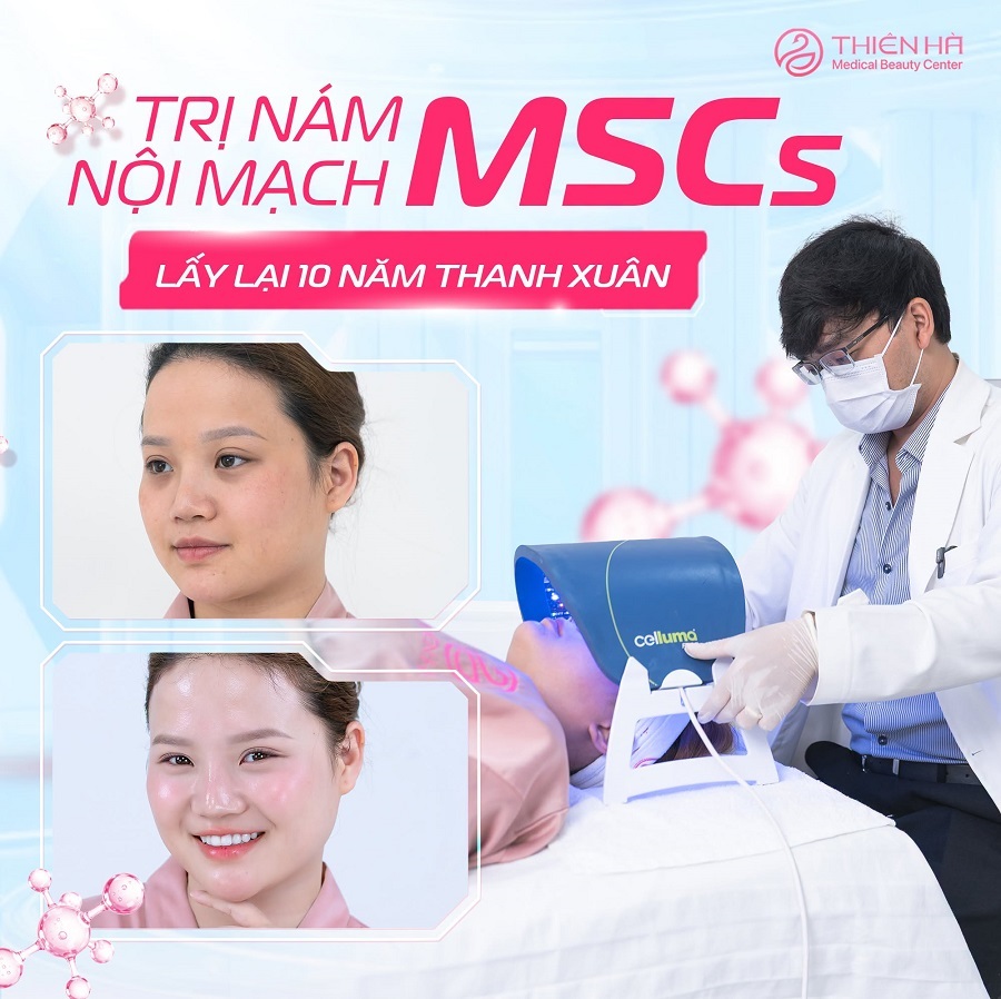 Dịch vụ trị nám bằng phác đồ nội mạch lạnh MSCs tại Viện thẩm mỹ Thiên Hà