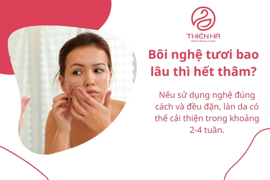 Bôi nghệ tươi có thể hết thâm nếu kiên trì sử dụng 