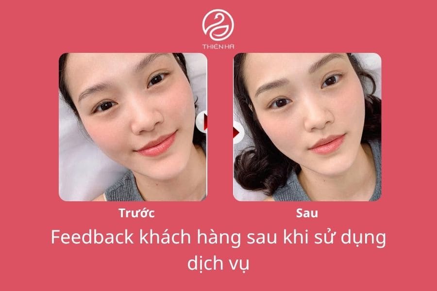 Cách làm môi hết thâm sau 1 đêm: Phương pháp nào hiệu quả? 8 Hình ảnh thực tế sau khi xóa thâm môi dứt điểm, hồng hào tự nhiên tại Viện Thẩm Mỹ Thiên Hà