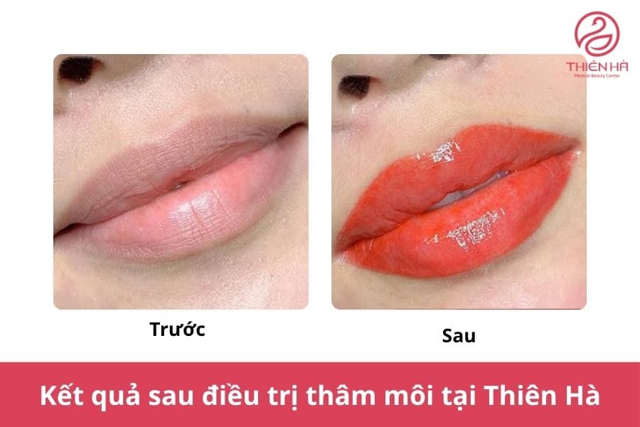 Cách trị thâm môi bằng vitamin E hiệu quả tại nhà 7 Dịch vụ điều trị thâm môi công nghệ cao luôn được ưu ái vì khả năng cải thiện thâm đến 99%