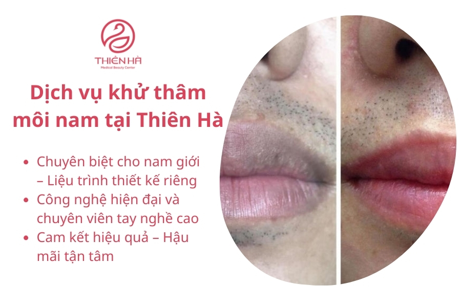 Thiên Hà sở hữu nhiều dịch vụ khử thâm môi nam đáng trải nghiệm 