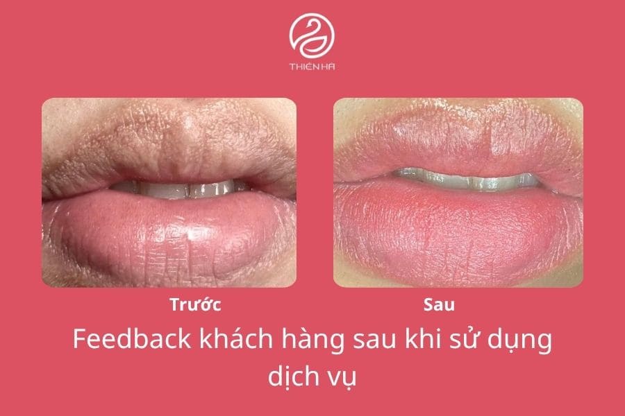 Hình ảnh trước và sau khi thực hiện khử thâm môi công nghệ cao