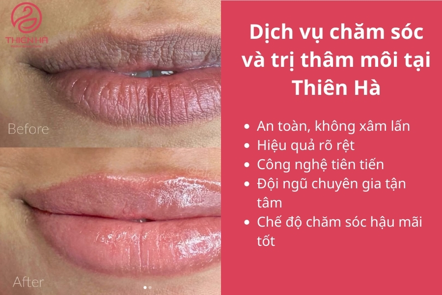 Điều trị thâm môi công nghệ cao cho hiệu quả đến 99%