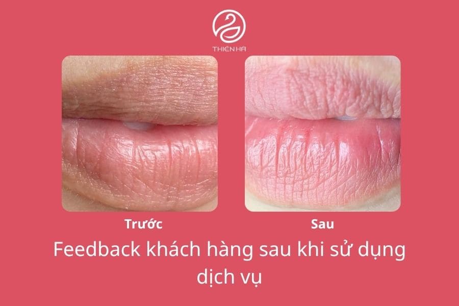 Môi thâm thiếu chất gì? 5 dưỡng chất cần bổ sung ngay! 5 Thiên Hà sở hữu nhiều công nghệ trị thâm môi hiện đại giúp lấy lại đôi môi hồng hào, tươi tắn