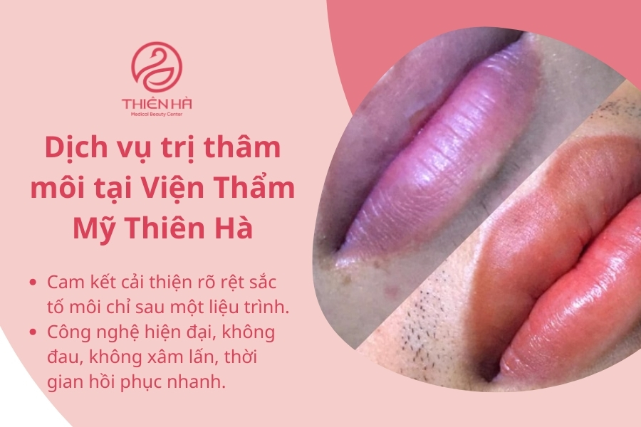Trị thâm môi công nghệ cao là dịch vụ được nhiều người lựa chọn tại Thiên Hà