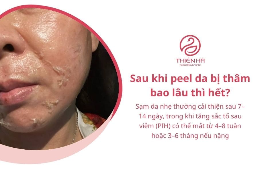 Sau khi peel da bị thâm bao lâu phụ thuộc vào nguyên nhân gây thâm, mức độ tổn thương da, cơ địa tăng sắc tố và cách chăm sóc