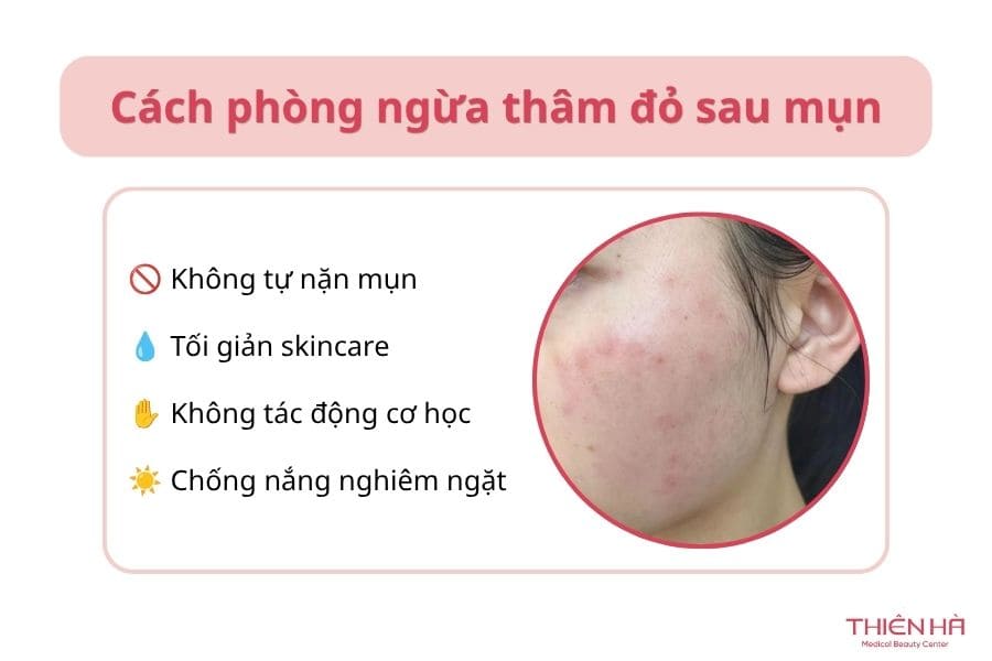 Thâm đỏ là gì? Thâm đỏ bao lâu thì hết và cách trị hiệu quả nhất 9 Cách phòng ngừa thâm đỏ sau mụn