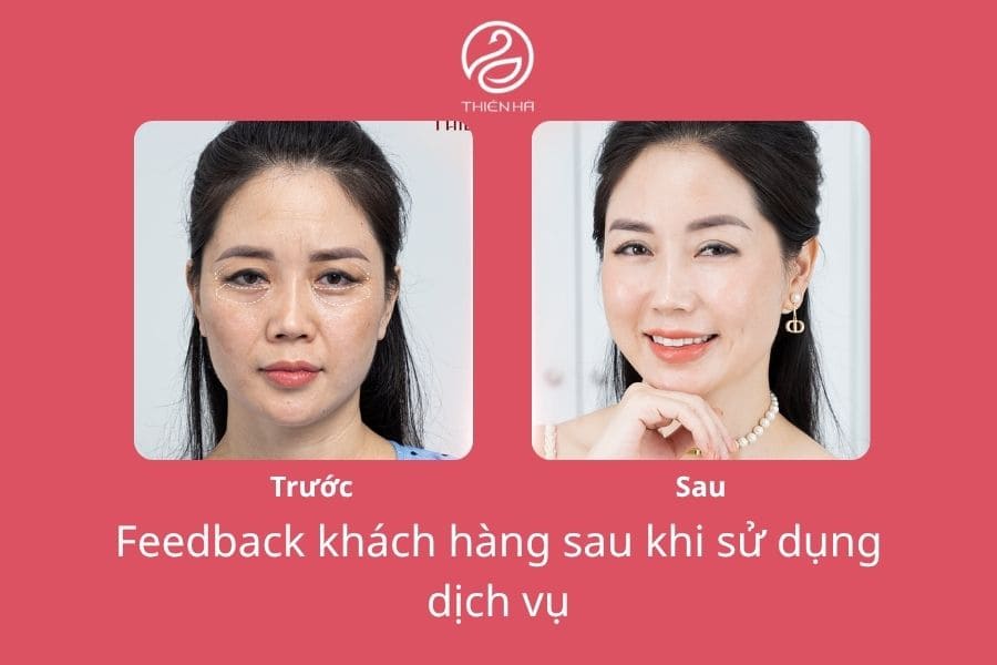 Nếu bạn đang tìm kiếm một địa chỉ trị thâm mắt bằng laser uy tín, Viện Thẩm Mỹ Thiên Hà chính là lựa chọn lý tưởng để giúp bạn sở hữu đôi mắt tươi trẻ, tràn đầy sức sống