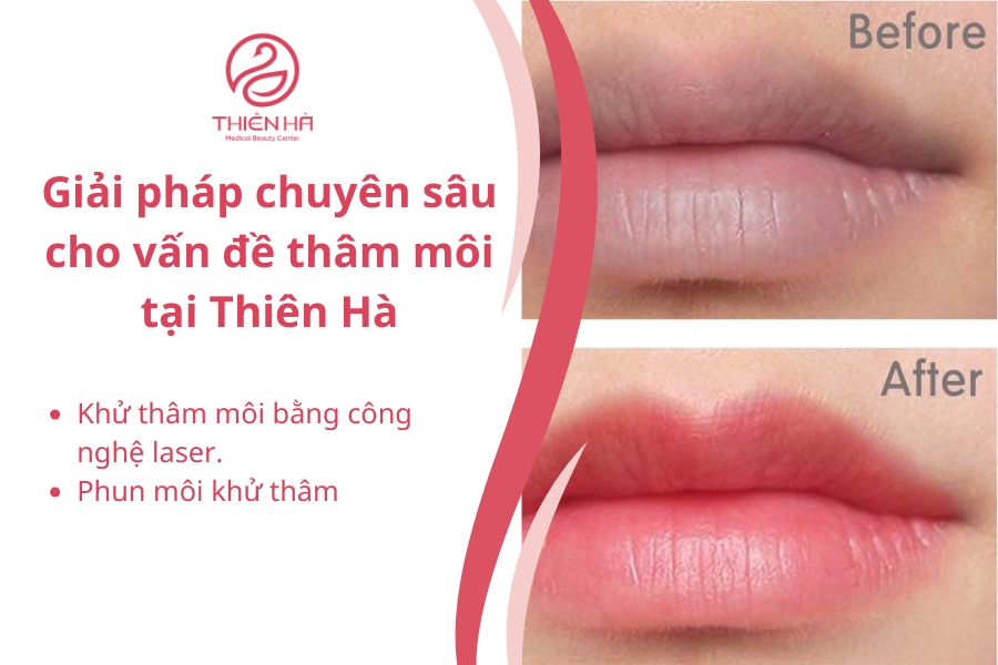 Thiên Hà sở hữu công nghệ trị thâm môi hàng đầu
