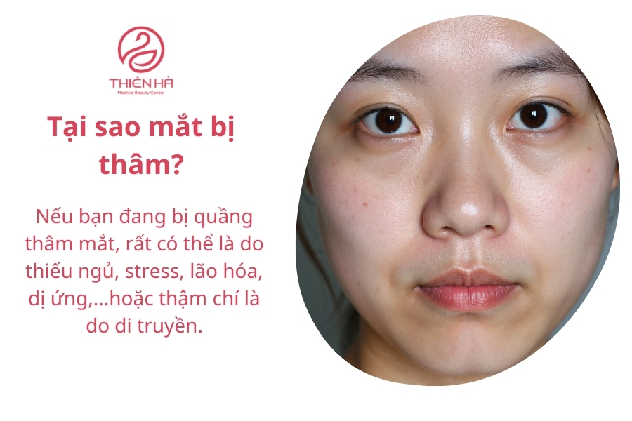 Các yếu tố thường gặp gây thâm quầng mắt