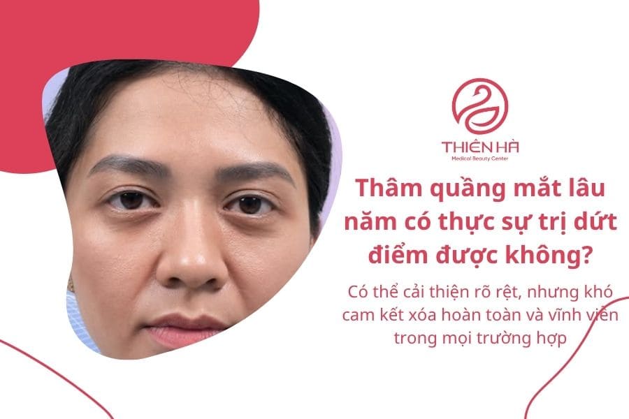 Cách trị thâm mắt lâu năm hiệu quả cao từ bác sĩ 1 Thâm quầng mắt lâu năm có thực sự trị dứt điểm được không?