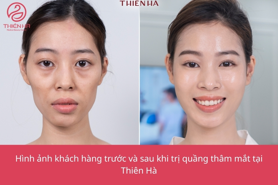Thiên Hà luôn là địa chỉ được ưu ái hàng đầu khi khách hàng tìm cách trị thâm mắt lâu năm