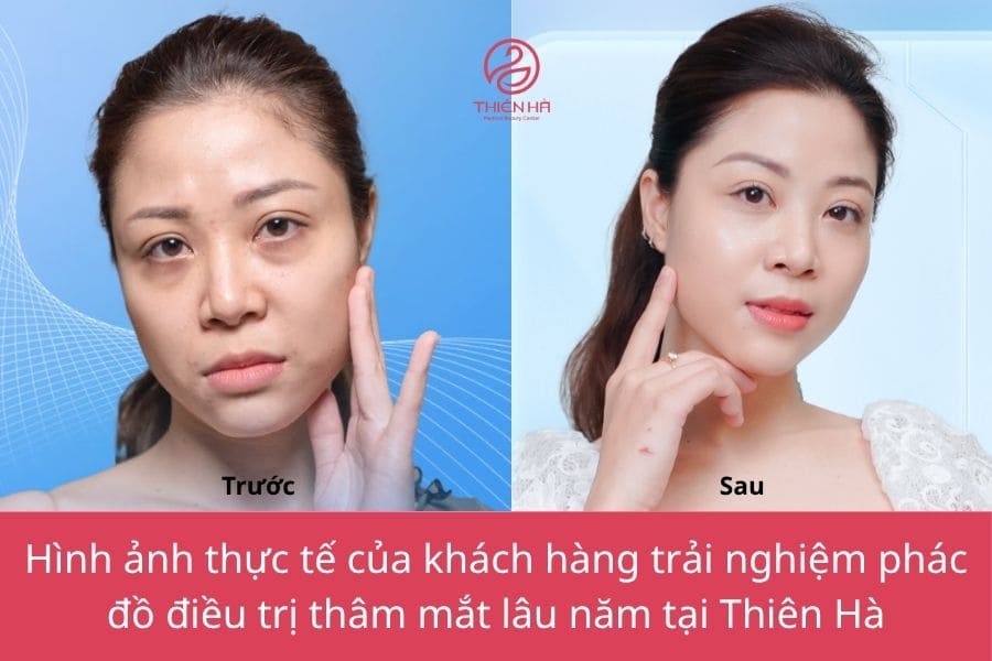 Cách trị thâm mắt lâu năm hiệu quả cao từ bác sĩ 5 Hình ảnh thực tế trước và sau khi thực hiện trị thâm quầng mắt lâu năm tại Thẩm mỹ viện Thiên Hà