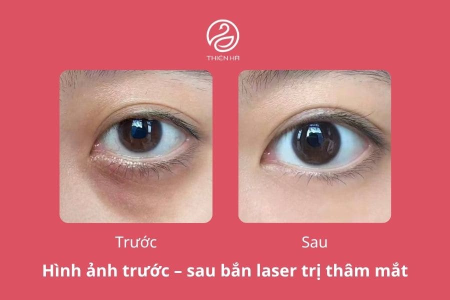 Công nghệ trị thâm mắt nào hiệu quả? Cách lựa chọn phù hợp 3 Hình ảnh trước và sau khi điều trị thâm mắt bằng công nghệ laser hiện đại