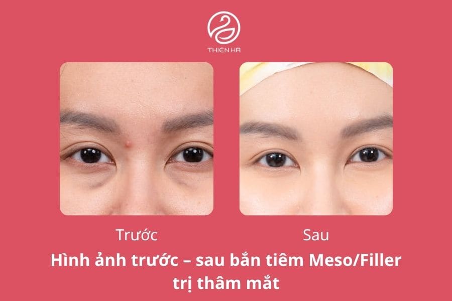 Công nghệ trị thâm mắt nào hiệu quả? Cách lựa chọn phù hợp 5 Công nghệ tiêm cấy vi điểm Meso/Filler giúp trị thâm mắt hiệu quả