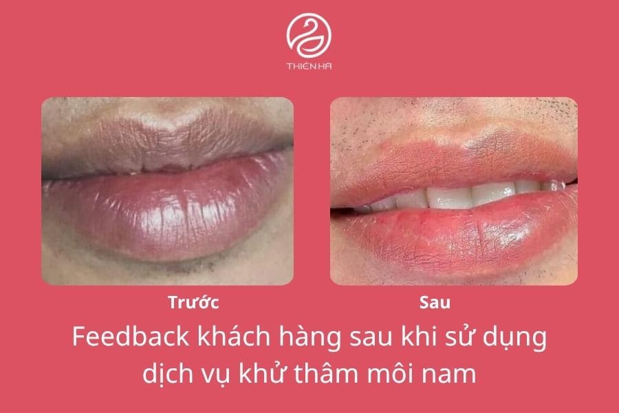 Hình ảnh trước và sau cho thấy môi được cải thiện sắc tố rõ rệt, vẫn giữ nét nam tính và tự nhiên sau điều trị