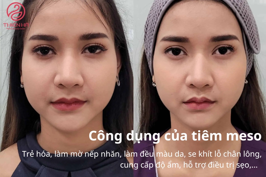 Hình ảnh cô gái trước và sau khi tiêm meso, có thể thấy khuôn mặt đã thon gọn hơn rất nhiều 