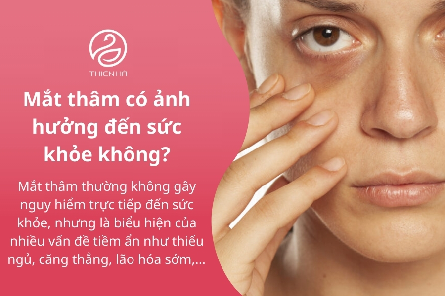 Mắt thâm là tình trạng phổ biến có thể gặp ở mọi lứa tuổi 