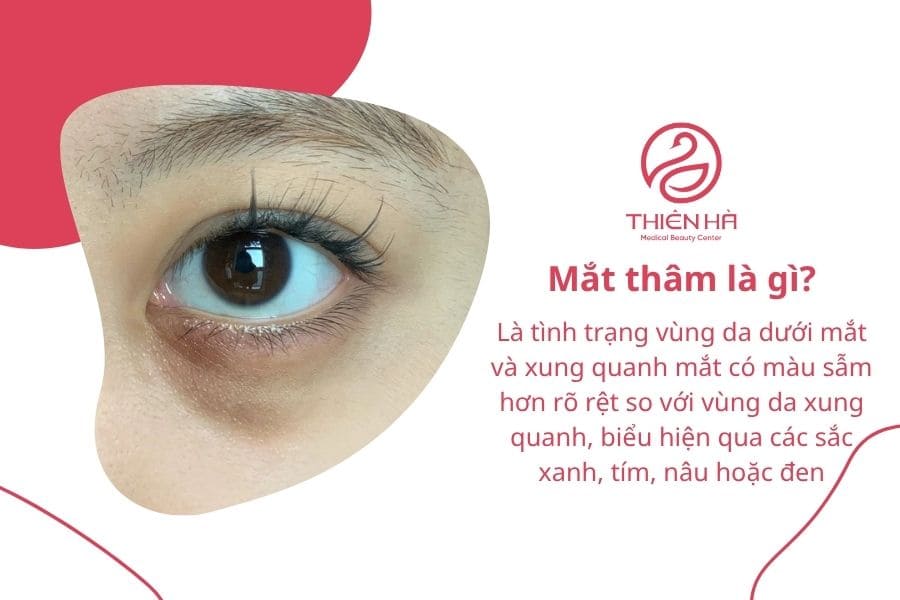 Mắt thâm là gì? Nguyên nhân, dấu hiệu và cách cải thiện hiệu quả 1 Mắt thâm là gì?