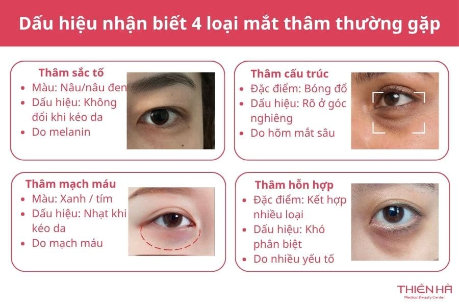 Mắt thâm là gì? Nguyên nhân, dấu hiệu và cách cải thiện hiệu quả 2 Hình ảnh và dấu hiệu nhận biết 4 loại mắt thâm thường gặp