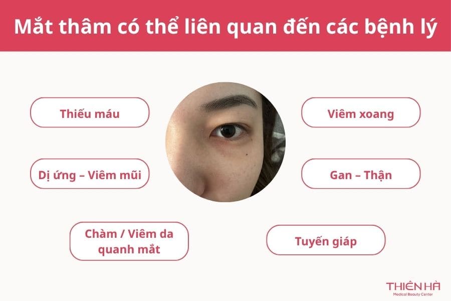 Mắt thâm là gì? Nguyên nhân, dấu hiệu và cách cải thiện hiệu quả 5 Nếu quầng thâm xuất hiện đột ngột hoặc kèm triệu chứng bất thường thì nên đi khám để xác định xem nguyên nhân thâm mắt có phải là do bệnh lý hay không