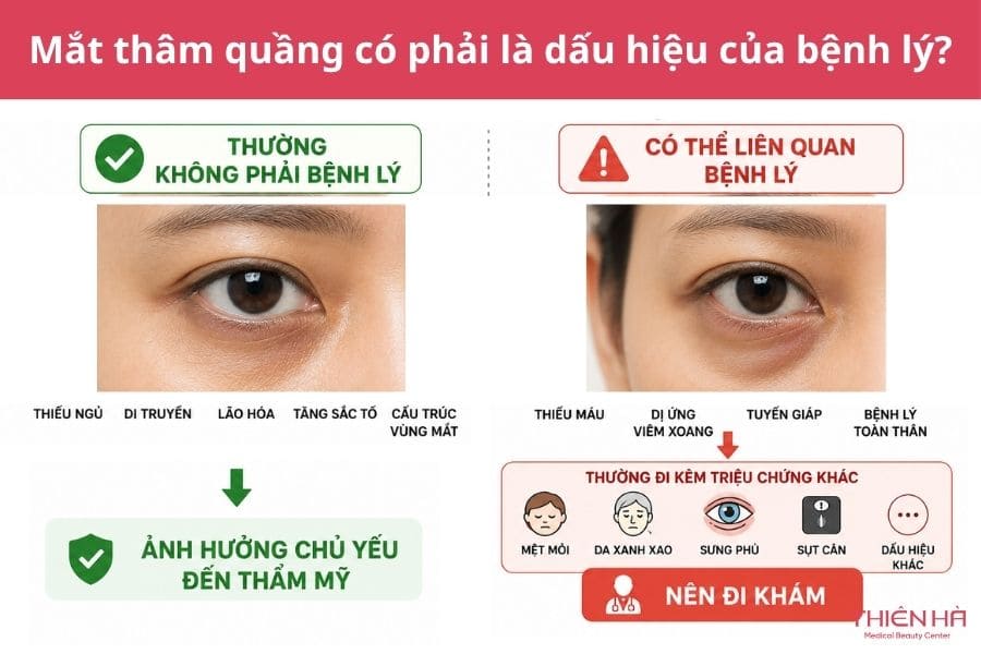 Mắt thâm quầng là bệnh gì? Có phải dấu hiệu cảnh báo bệnh lý? 1 Thực tế: Mắt thâm quầng có phải là dấu hiệu của bệnh lý?
