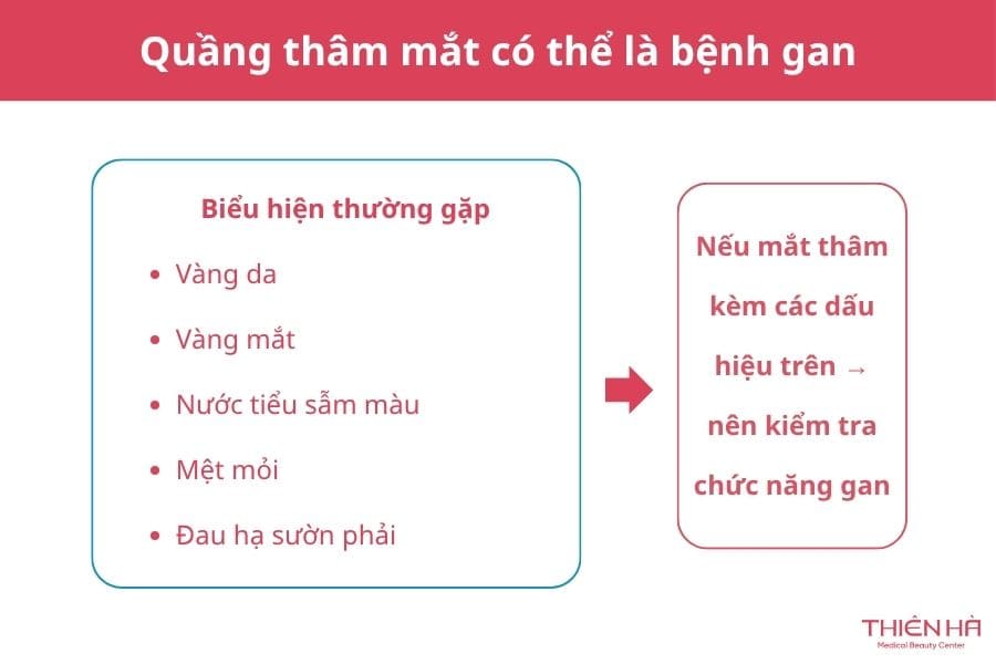 Mắt thâm quầng là bệnh gì? Có phải dấu hiệu cảnh báo bệnh lý? 3 Quầng mắt thâm đen bệnh gì? Có thể là bệnh gan nếu đi kèm một số dấu hiệu