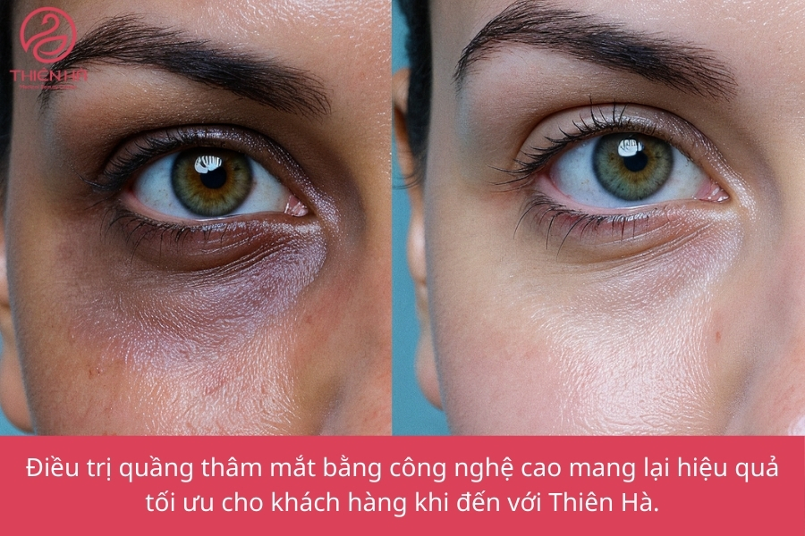 Hình ảnh mô phỏng kết quả điều trị thâm quầng mắt. Hiệu quả rõ rệt chỉ sau vài buổi!