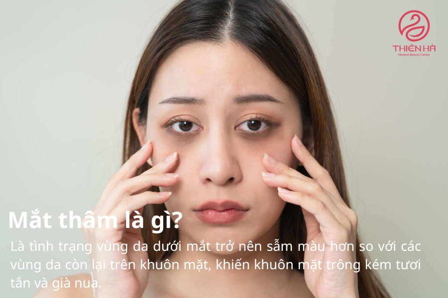 Mắt thâm khiến vùng da quanh mắt nhanh lão hóa hơn và kém sắc