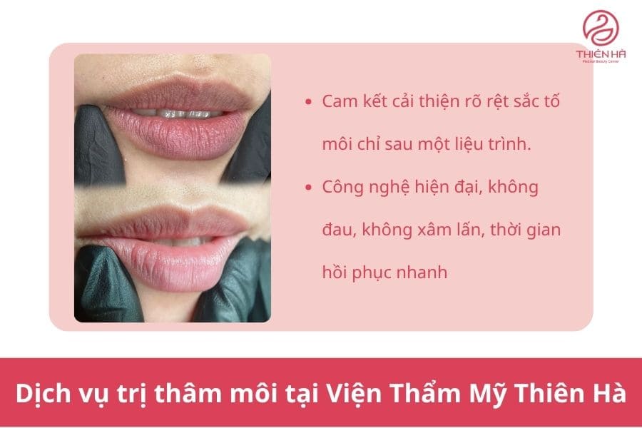 Trị thâm môi công nghệ cao là dịch vụ được nhiều người lựa chọn tại Thiên Hà