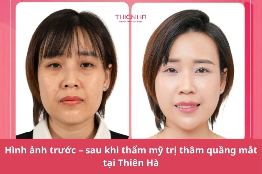 Thẩm mỹ trị thâm quầng mắt ở đâu uy tín? Tiêu chí lựa chọn 7 Hình ảnh trước – sau điều trị giúp khách hàng tham khảo mức độ cải thiện quầng thâm thực tế tại Thẩm mỹ viện Thiên Hà