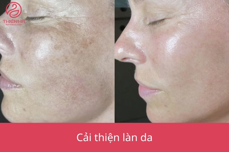 Hình ảnh so sánh làn da trước và sau khi tiêm meso, cho thấy sự cải thiện rõ rệt về độ sáng, độ mịn và sự săn chắc của làn da.