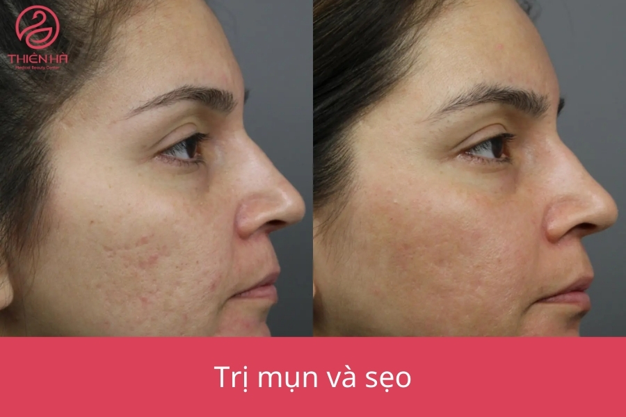 Hình ảnh cho thấy sự cải thiện của làn da sau liệu trình tiêm meso trị sẹo, giúp da mịn màng và đều màu hơn rõ rệt.