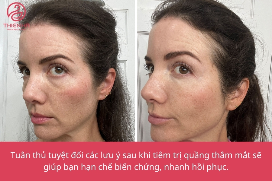 Việc chăm sóc đúng cách sẽ giúp vùng da dưới mắt phục hồi nhanh chóng và duy trì hiệu quả làm sáng, mờ thâm lâu dài.
