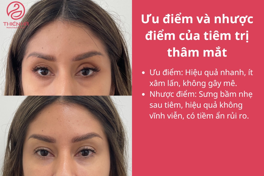 Các ưu nhược điểm của việc tiêm trị thâm mắt 