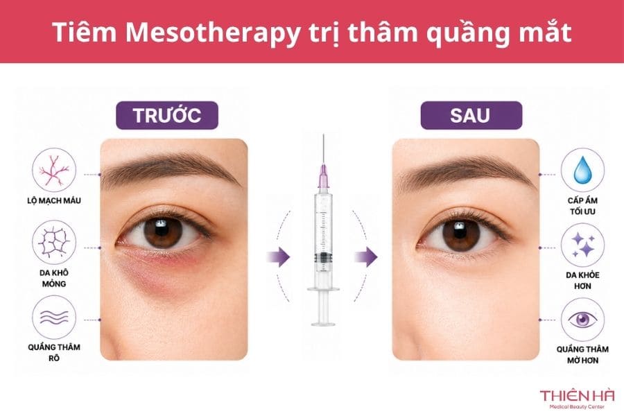 Tiêm trị thâm mắt có hiệu quả không? Các phương pháp phổ biến 5 Tiêm Mesotherapy trị thâm quầng mắt