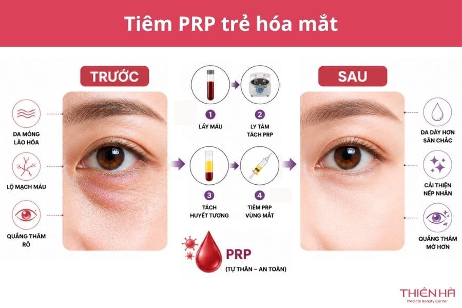 Tiêm trị thâm mắt có hiệu quả không? Các phương pháp phổ biến 6 Tiêm PRP trẻ hóa mắt