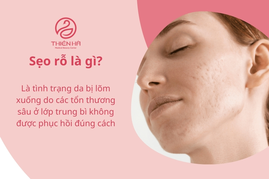 Sẹo rỗ khiến da mặt kém mịn màng và mất thẩm mỹ 