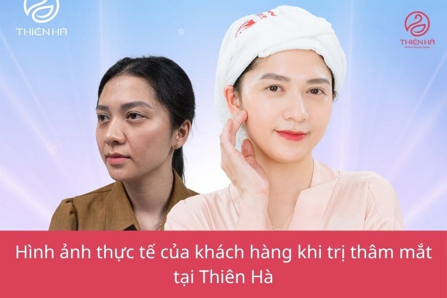 Trị thâm mắt: Cách lựa chọn phương pháp phù hợp và hiệu quả 5 Kết quả điều trị của khách hàng sau khi trị thâm mắt tại Thẩm mỹ viện Thiên Hà