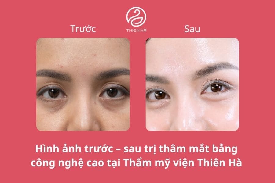 Cách trị thâm quầng mắt sau 1 đêm cực kì hiệu quả 7 Hình ảnh thực tế cho thấy vùng da dưới mắt sáng và đều màu hơn sau điều trị tại Thẩm mỹ viện Thiên Hà
