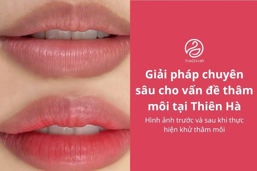 Thiên Hà sở hữu công nghệ trị thâm môi hàng đầu